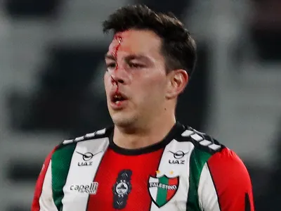 Impactante: Así quedó el rostro de Fernando Meza tras la patada que le propinó Jeyson Rojas en el triunfo de Colo-Colo