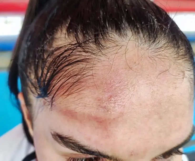 Así quedó la frente de Javiera Grez tras el partido entre Colo-Colo y Deportes Antofagasta.