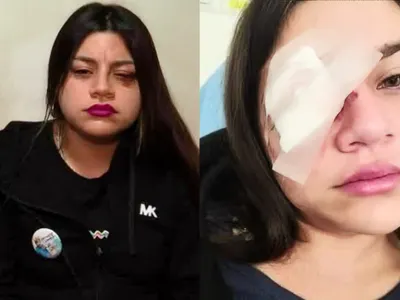 «Me dejaron muerta en vida»: El crudo relato de la joven que perdió la visión de su ojo por culpa de un Arengazo