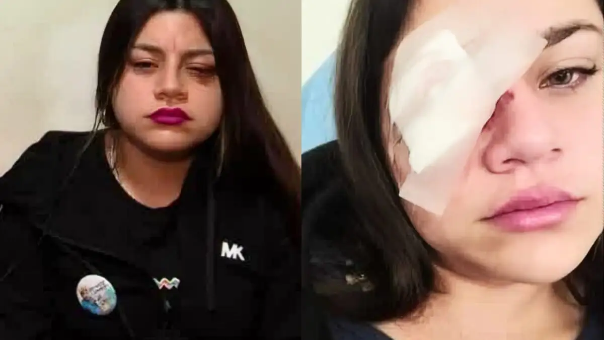 Yomara Segovia tras recibir un piedrazo en su ojo durante un Arengazo en el Estadio Monumental.